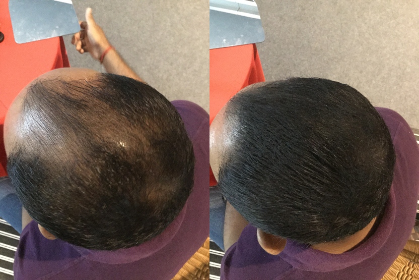 hafiq using toppik instant hair transplant