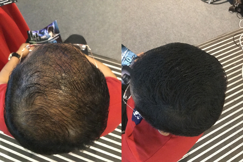 amrul use toppik and get instant professional hair treatment result