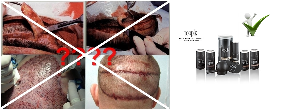 Hair Transplant In Malaysia