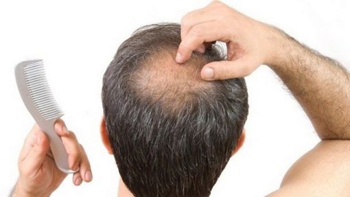hair loss and hair growth treatment malaysia 