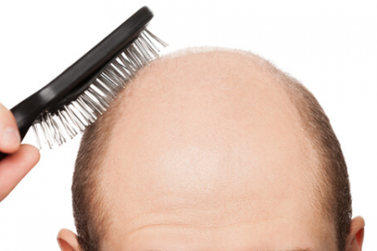 male pattern baldness