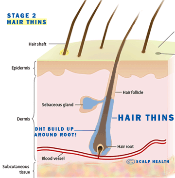 ANTI DHT Hair Loss Treatment Malaysia [How To Combat DHT ...