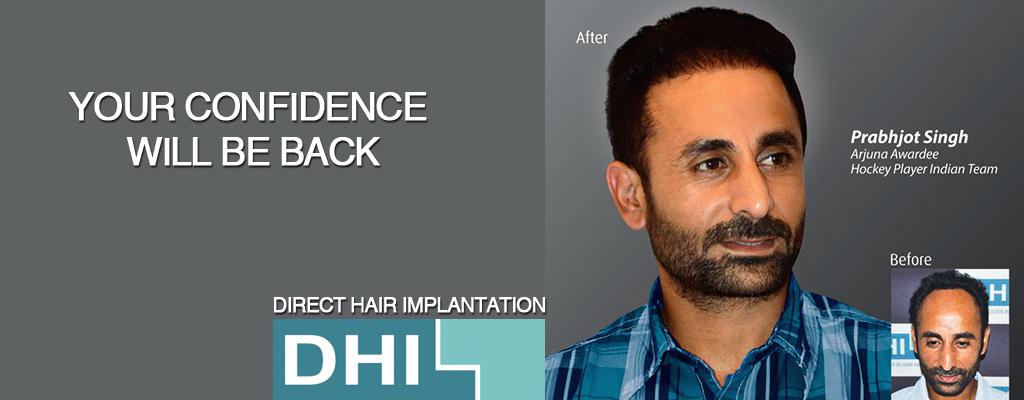 PRP hair transplant malaysia 