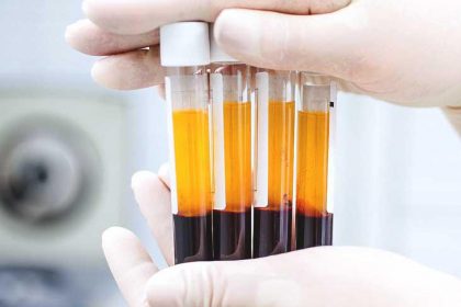 PRP hair transplant
