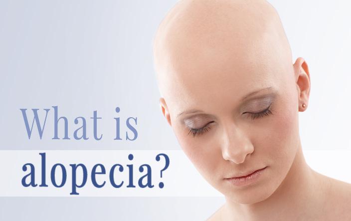 alopecia malaysia