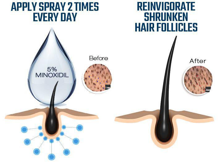 Minoxidil 101: Everything You Need To Know About Generic, 59% OFF