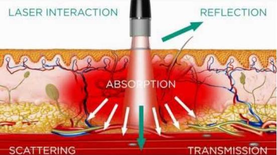 laser therapy for hair growth