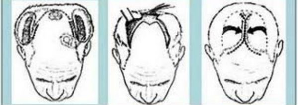 Pengurangan Kulit Kepala (Scalp Reduction)