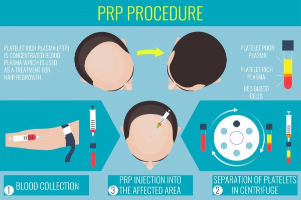 Platelet-Rich Plasma (PRP) Rawatan Sel Stem