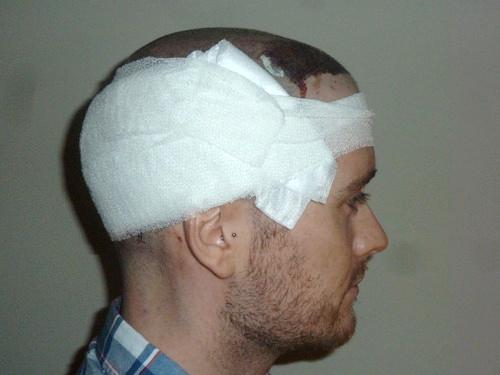 hair transplant murah